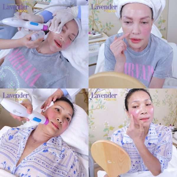 nang co thermage 26167 9 e1764730772884 - lavender by chang