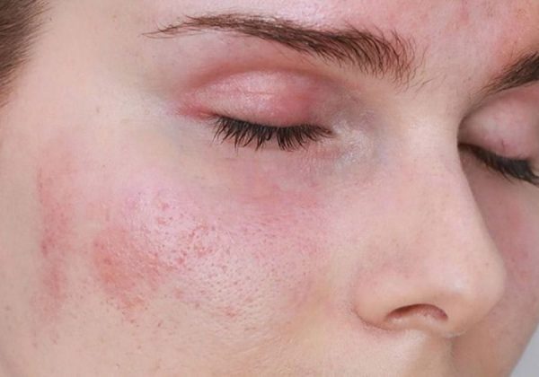 tac hai cua tri nam bang la trau khong 26479 1 e1765938745200 - lavender by chang