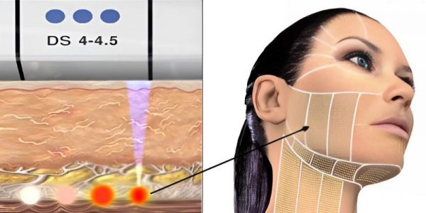 ultherapy co tot khong 26268 1 e1765164632752 - lavender by chang