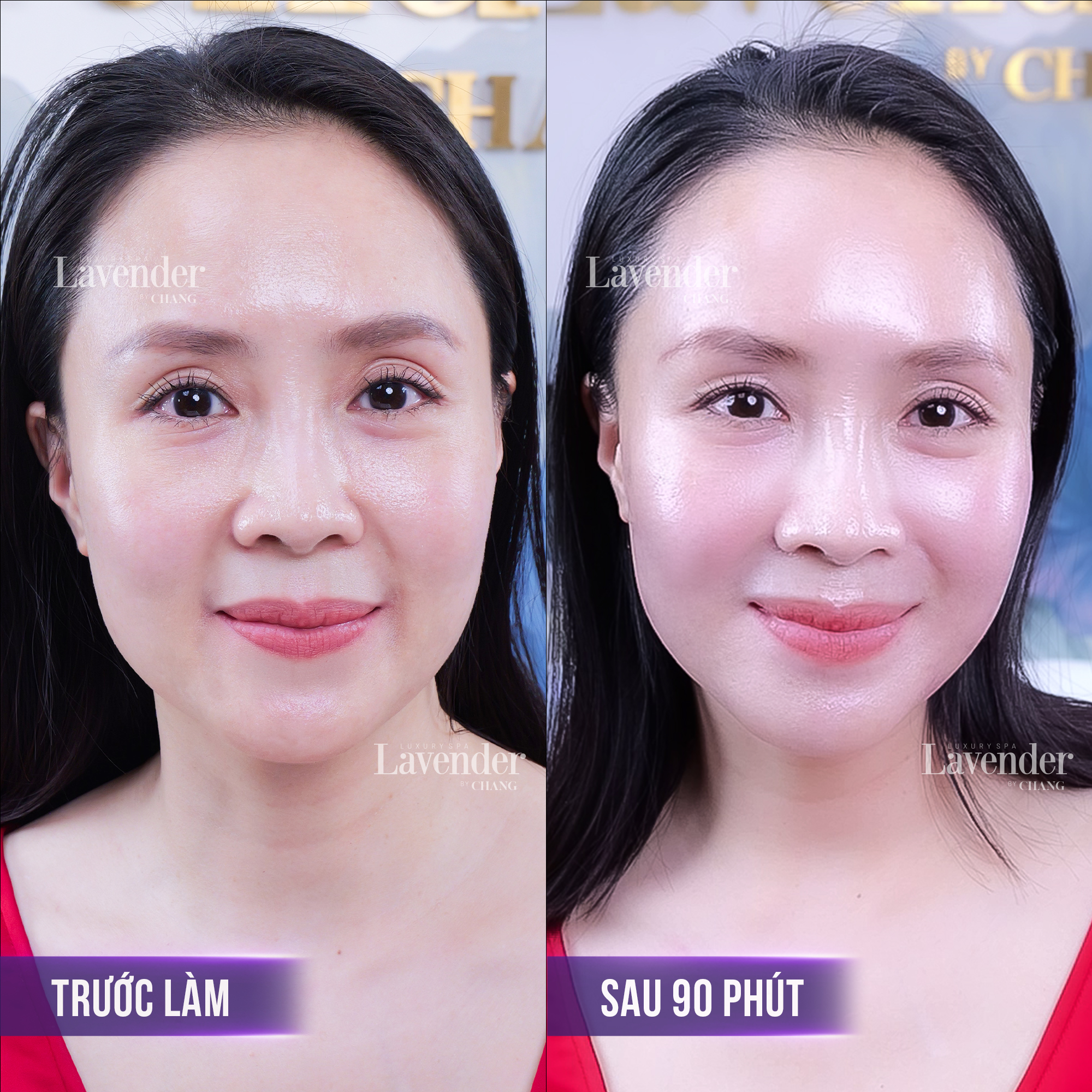 Kết quả thực tế sau liệu trình trẻ hoá làn da của diễn viên Hồng Diễm