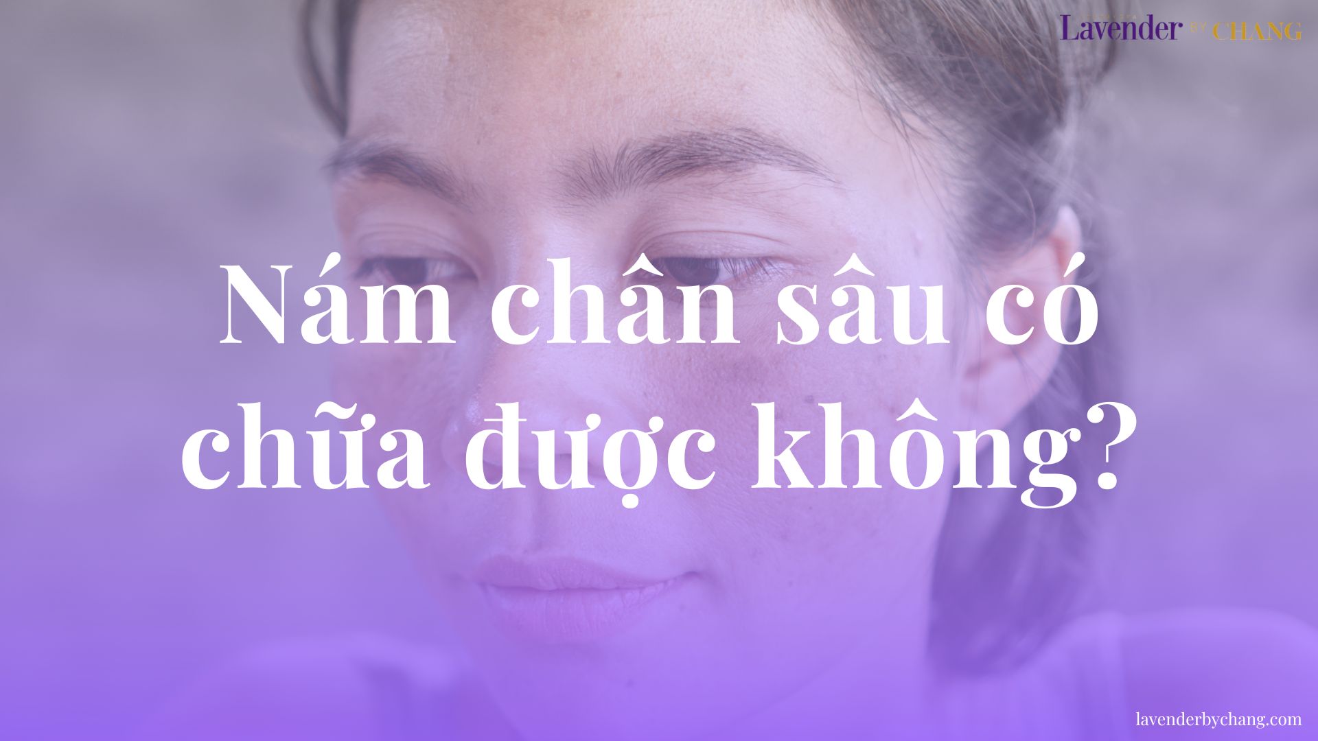 Nám Chân Sâu Có Chữa Được Không? 6 Phương Pháp Điều Trị