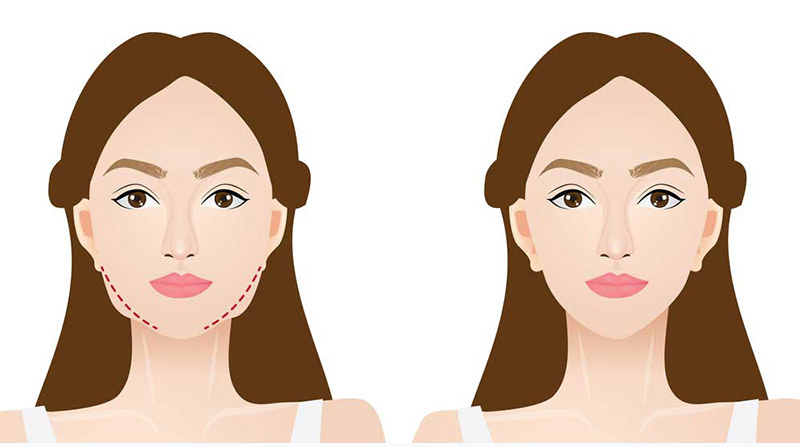 04 yếu tố ảnh hưởng tới chi phí hút mỡ má