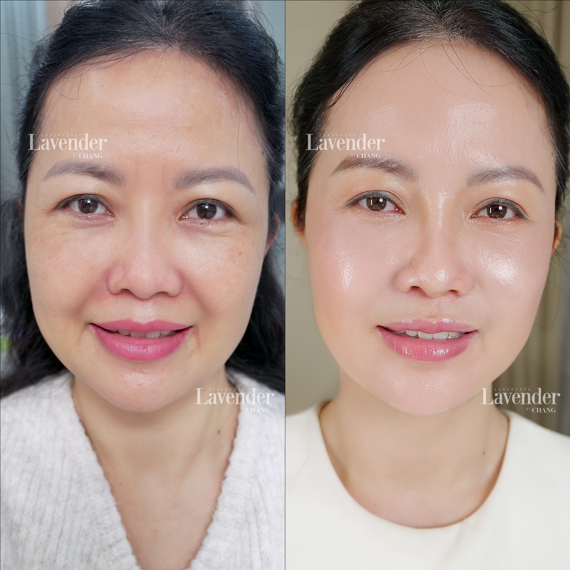 so sanh hifu va thermage 27687 9 - lavender by chang