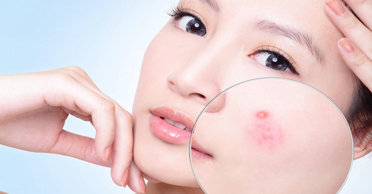 Khi nào bạn nên đến spa trị mụn tại Hà Nội?