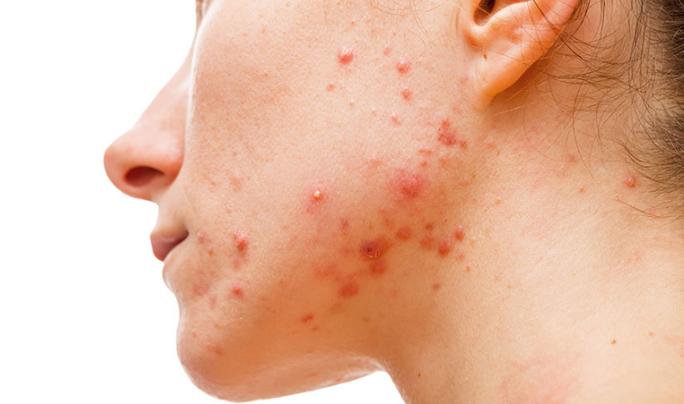 Mụn nội tiết hoàn toàn được cải thiện nhờ spa uy tín