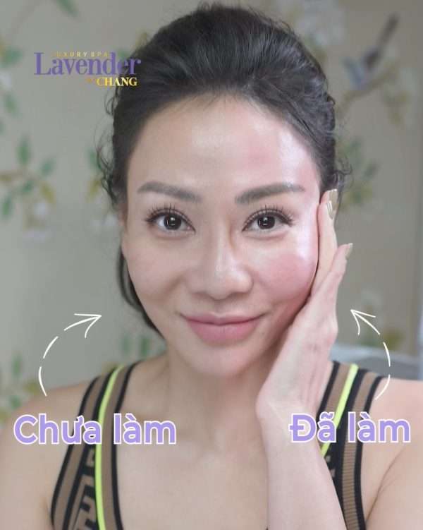 tac dung phu cua thermage 28000 1 - lavender by chang