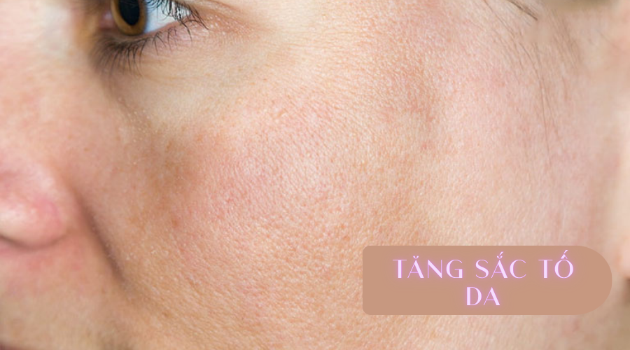 tac dung phu cua thermage 28000 3 - lavender by chang