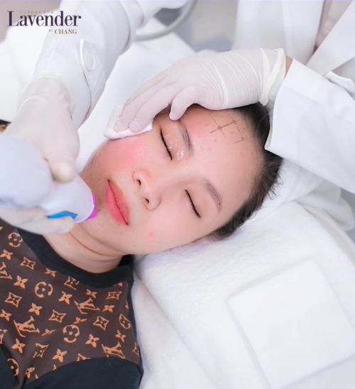 tac dung phu cua thermage 28000 - lavender by chang