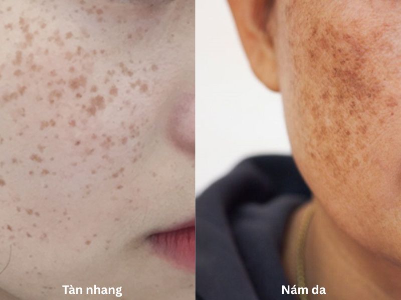 cach tri tan nhang bam sinh 29848 1 - lavender by chang