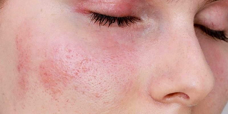 cham soc da sau laser tan nhang 29751 1 - lavender by chang
