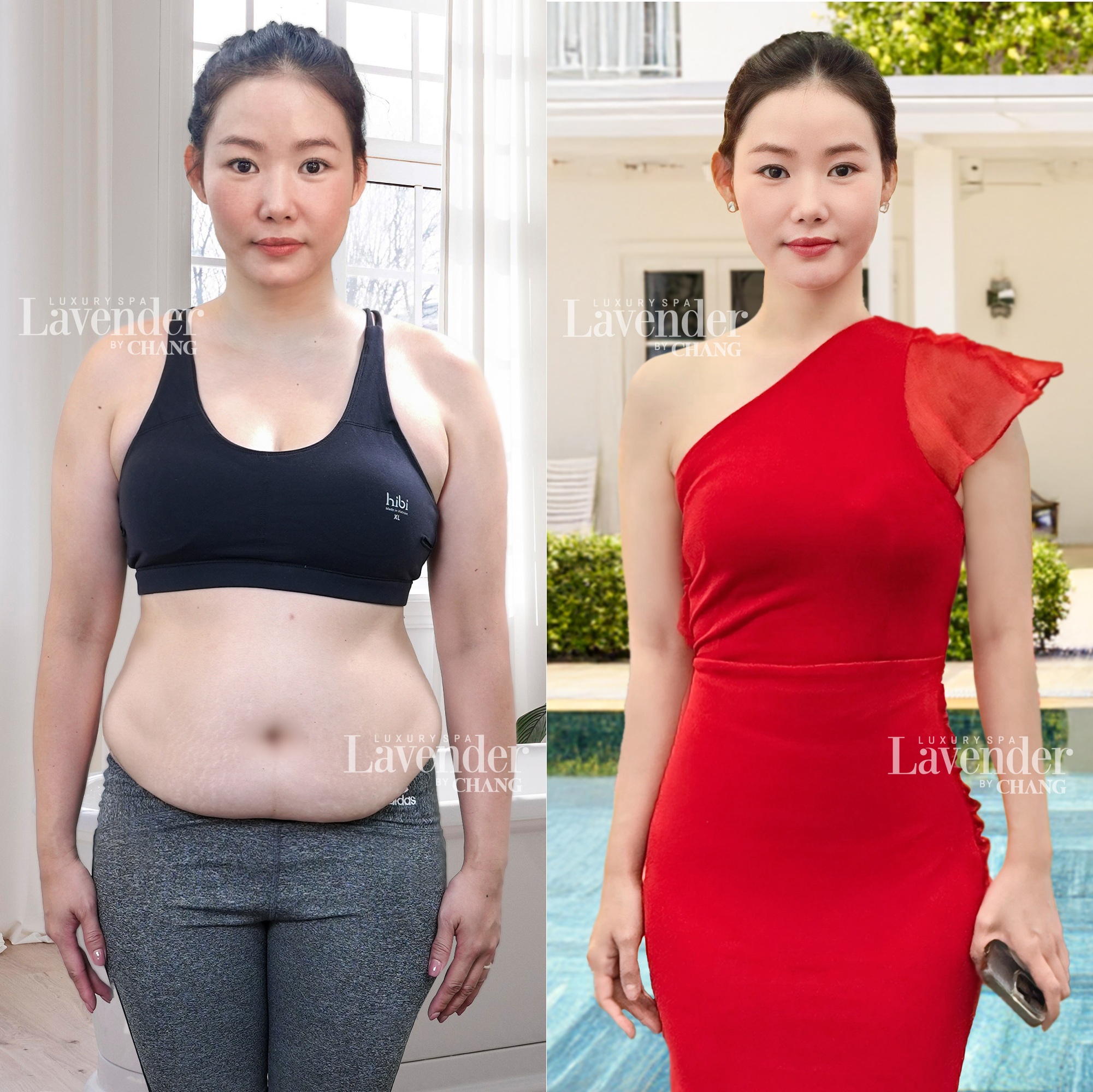 Hút mỡ bụng bao nhiêu tiền? Bảng giá cập nhật 2026