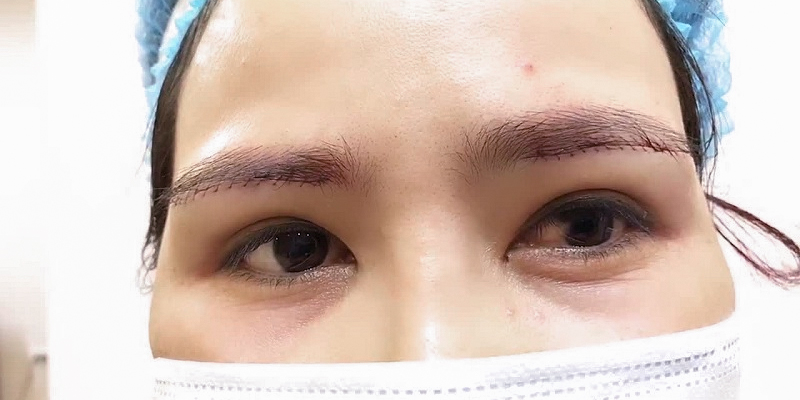 Nâng cung mày bao lâu thì hết sẹo