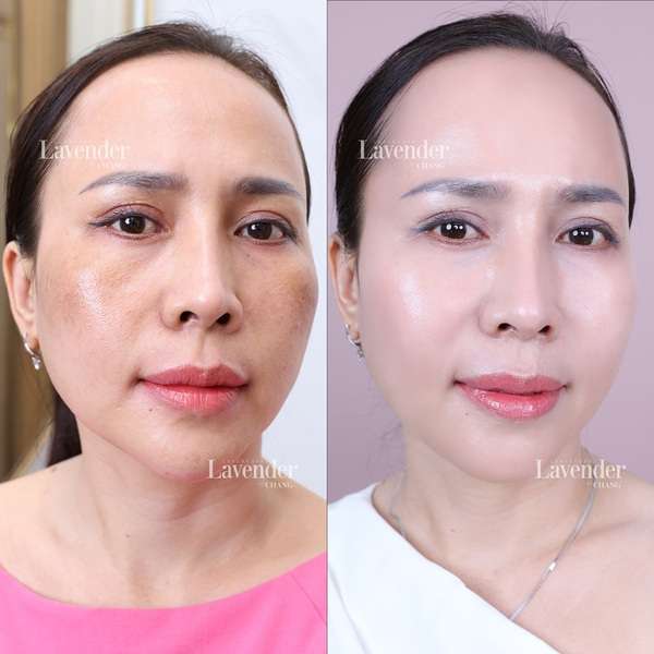 Khả năng xử lý sắc tố là một trong những tiêu chí quan trọng khi lựa chọn công nghệ trị nám tốt nhất hiện nay. 