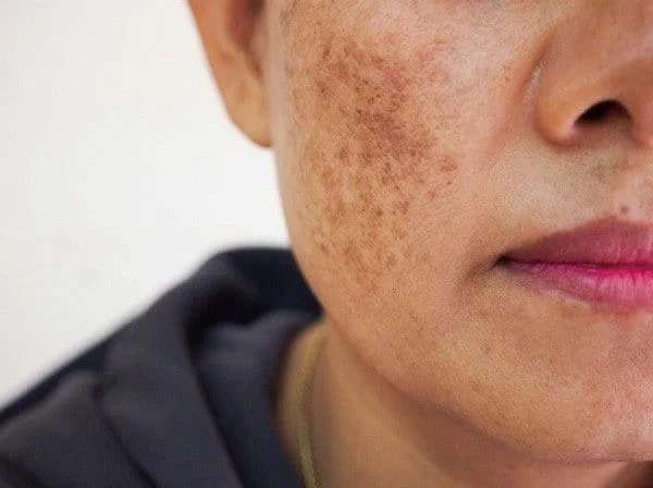 Người bị nám chân sâu có thể lựa chọn công nghệ Nanocell Diamond hoặc Biocell Complex.