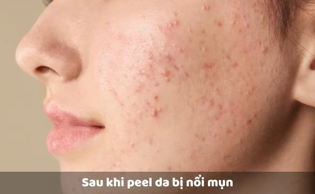dang cho con bu peel da duoc khong 30945 5 - lavender by chang