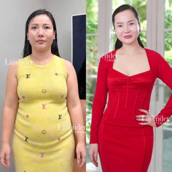 Vòng bụng trước và sau liệu trình giảm mỡ không phẫu thuật Carbolite của khách hàng tại Lavender By Chang.