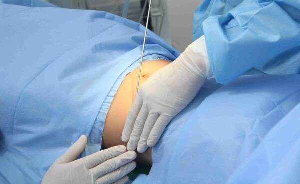 hút mỡ bụng là gì