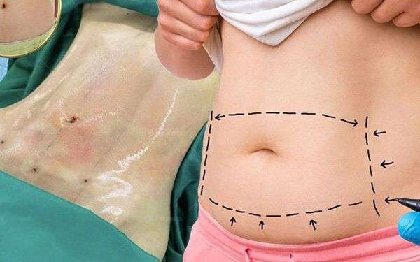 Bác sĩ đánh giá trực tiếp phạm vi hút mỡ để xác định chi phí phù hợp với từng trường hợp. 