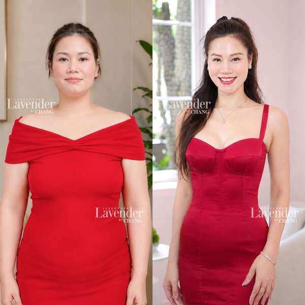 Sự thay đổi đường nét vùng bụng của khách hàng trước và sau 1 liệu trình Carbolite tại Lavender By Chang. 