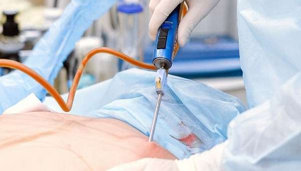 Diện tích và lượng mỡ cần hút là những yếu tố ảnh hưởng đến hút mỡ bụng cấy mông giá bao nhiêu.
