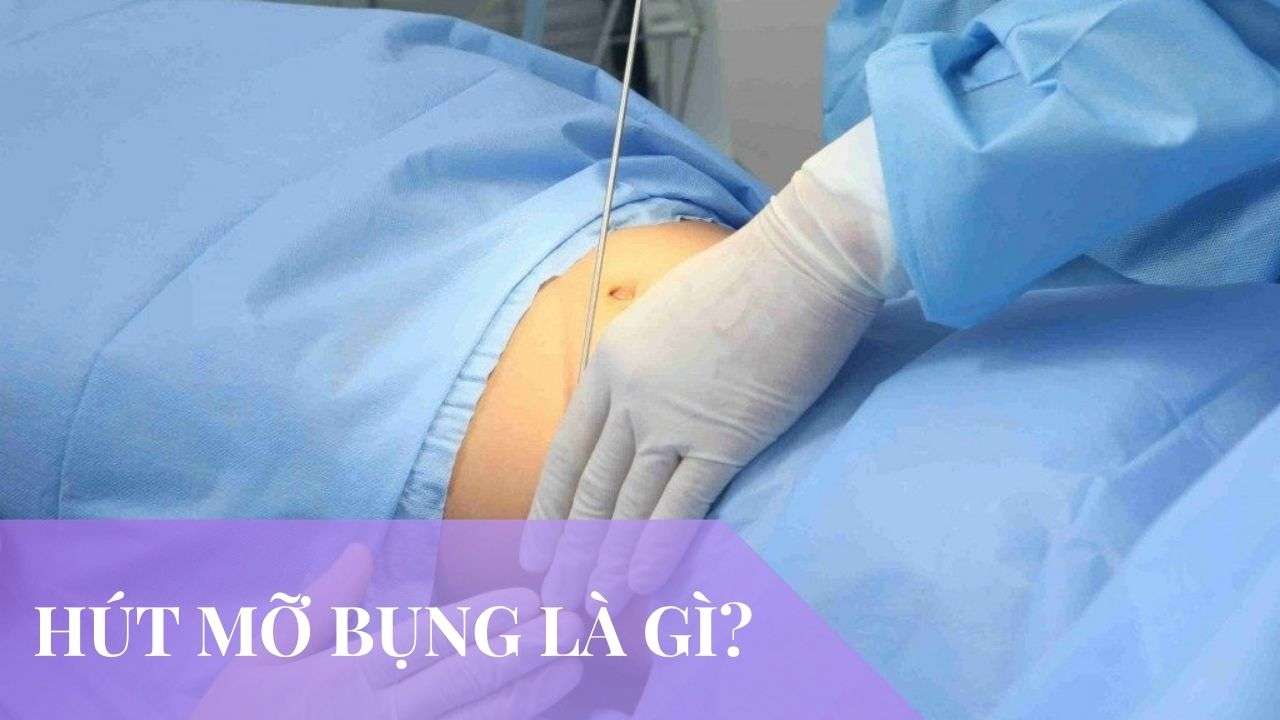 hút mỡ bụng