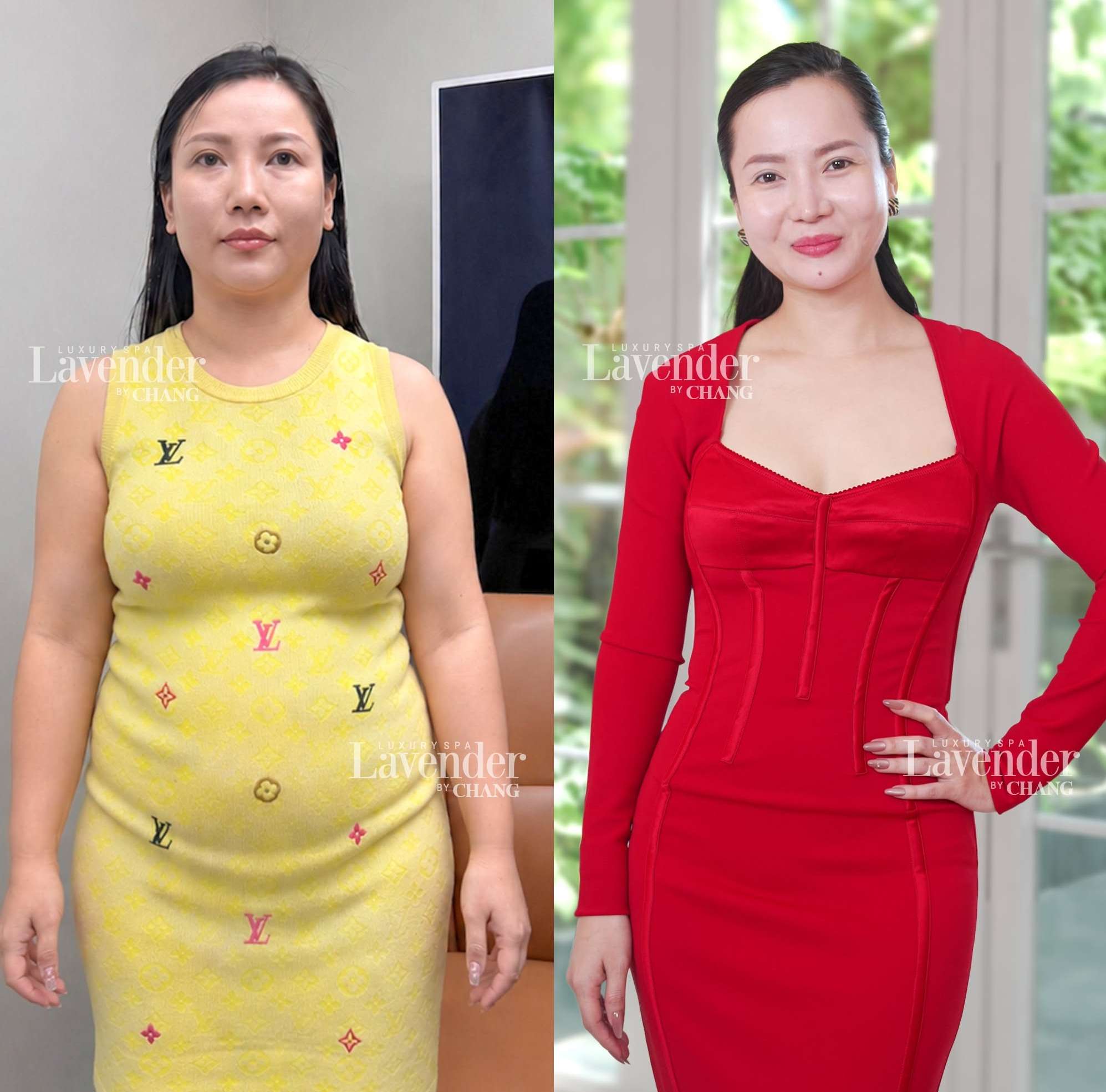 Hút mỡ toàn thân bao nhiêu tiền? Chi phí từng vị trí