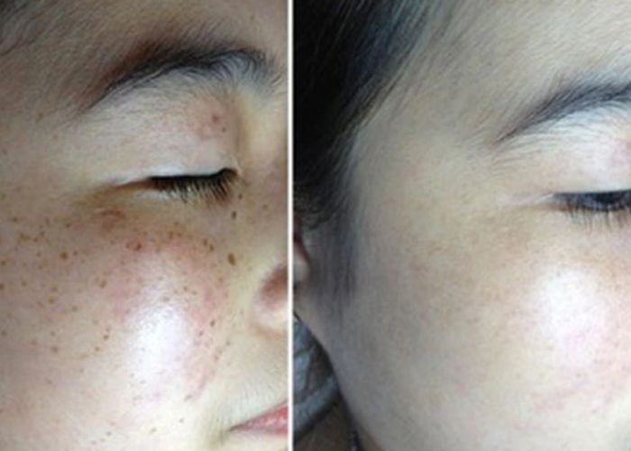 khoang cach giua cac lan ban laser tri nam 30482 1 - lavender by chang