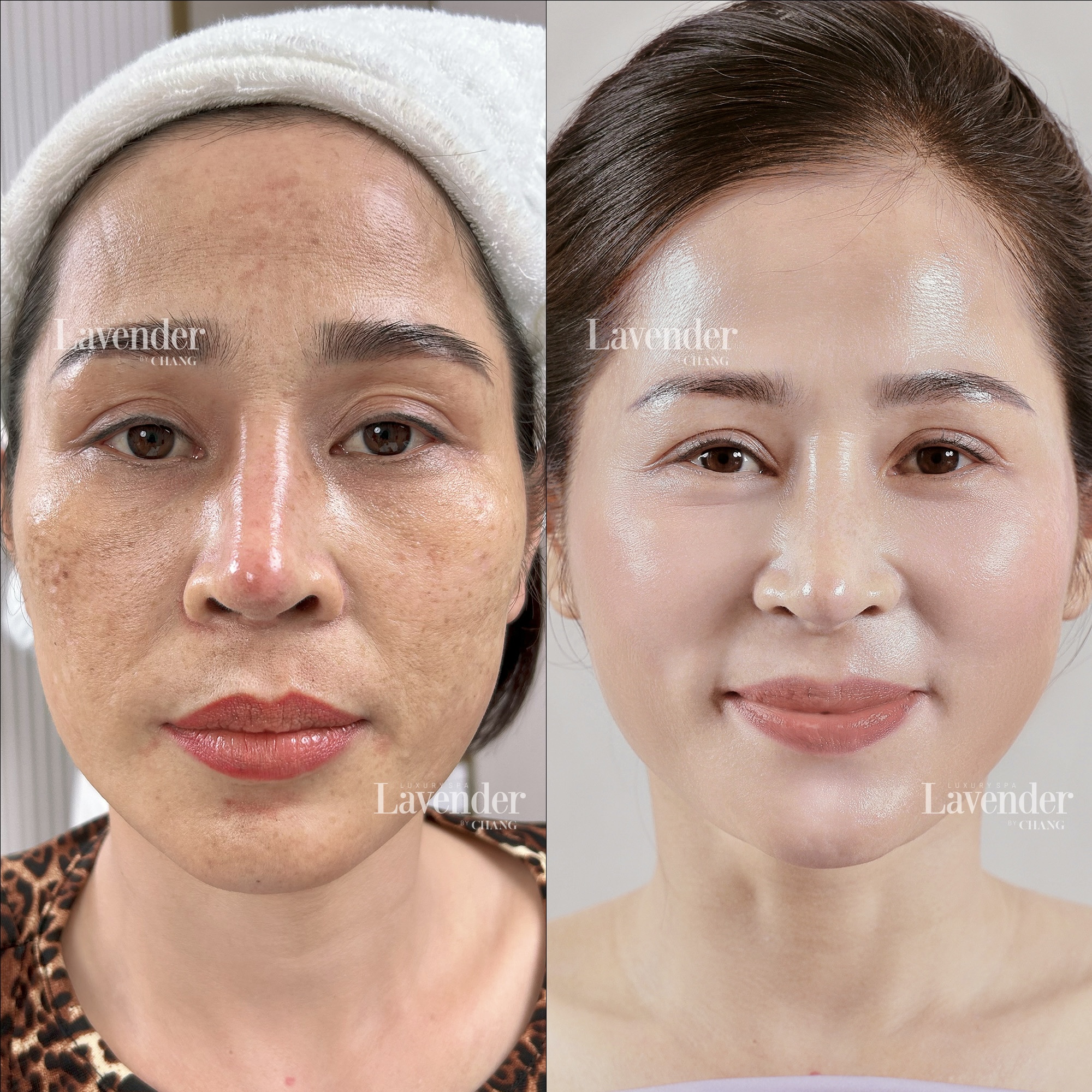 khoang cach giua cac lan ban laser tri nam 30482 - lavender by chang