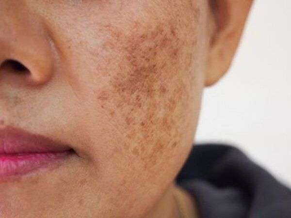 Tình trạng và độ sâu của sắc tố da ảnh hưởng đến laser pico giá bao nhiêu