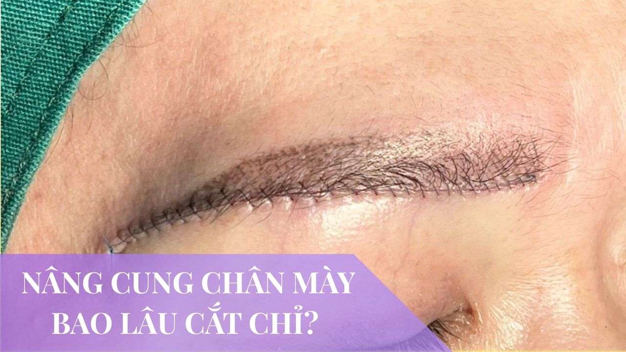 nâng cung chân mày bao lâu cắt chỉ