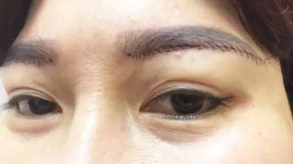 Cắt chỉ quá sớm khi vết mổ chưa ổn định có thể ảnh hưởng đến quá trình lành thương sau nâng cung mày.