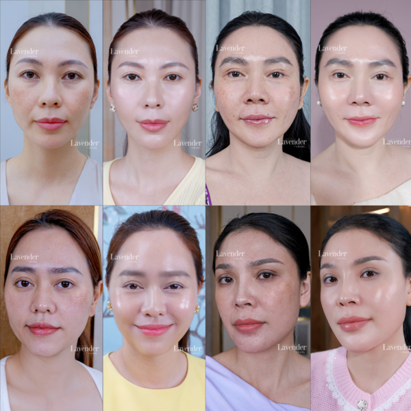 Hình ảnh làn da trước và sau điều trị nám của một số khách hàng tại Lavender By Chang.
