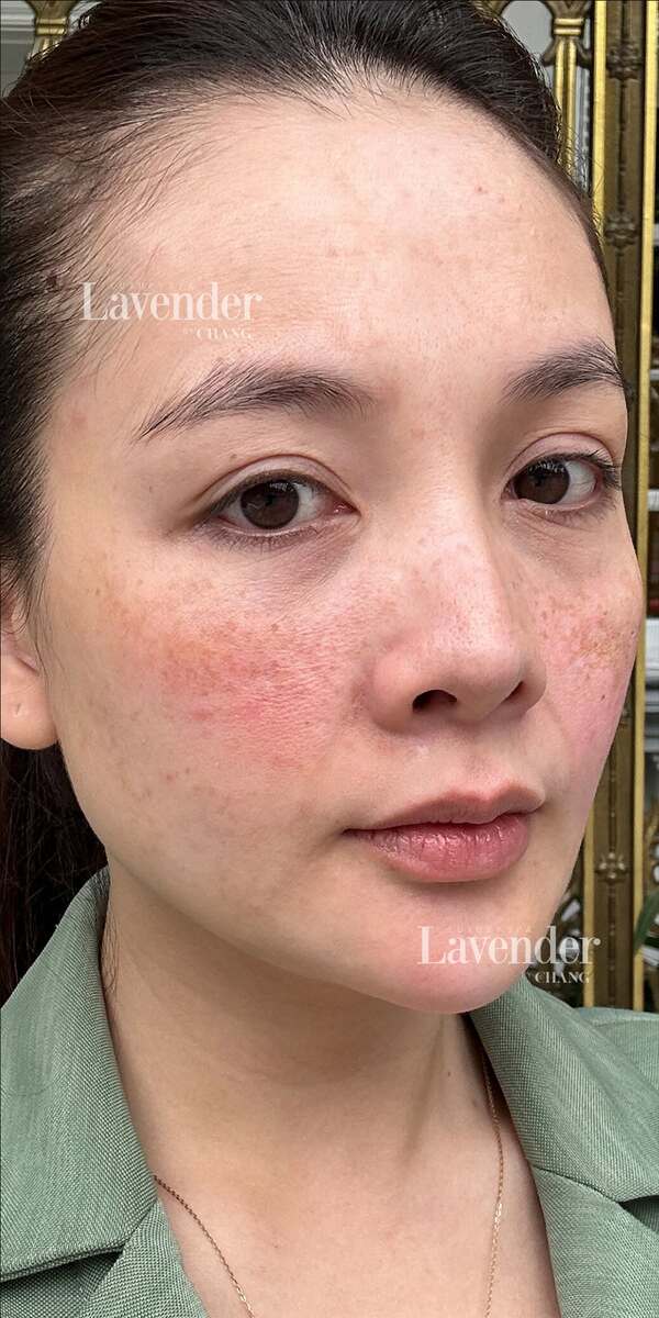 Các yếu tố làm nám tái phát sau laser gồm ánh nắng, nội tiết và chăm sóc da chưa phù hợp