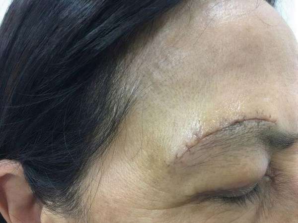 Sau nâng chân mày, nếu sưng tăng hoặc đau tăng, cần liên hệ bác sĩ ngay. 